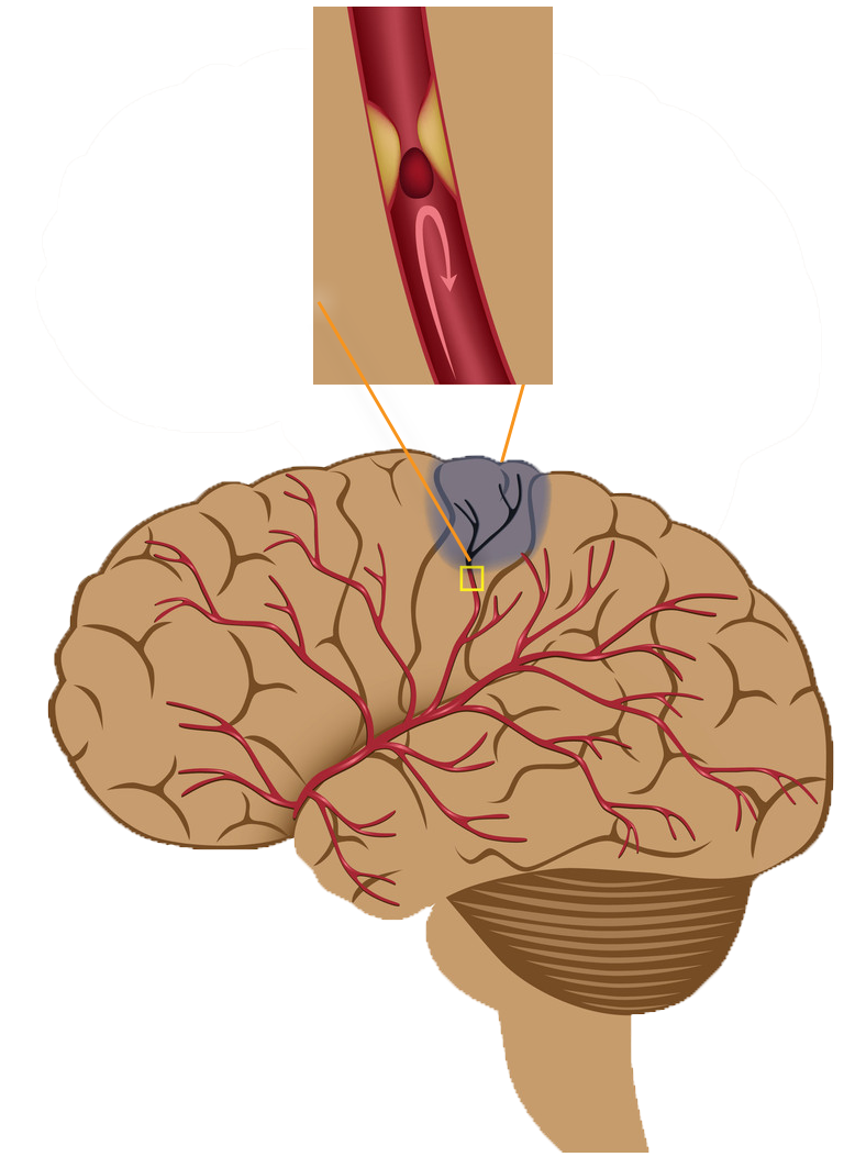 Blockage of an artery